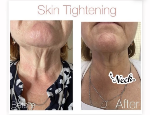 Skin Tightening